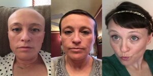 hair growth after chemo treatment in Springdale